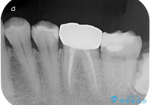 割れた奥歯の再修復　土台からの治療の治療後