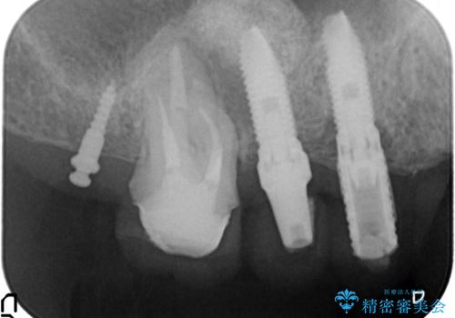 [天然歯の遠心移動]  適切なインプラントー歯牙距離を確保するの治療中