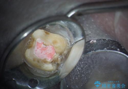 割れた奥歯の再修復　土台からの治療の治療中