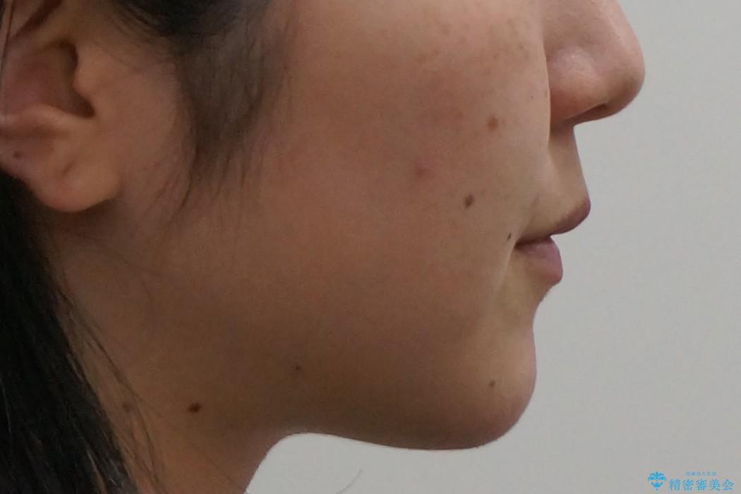 20代女性　前歯のがたがた　後ろに引っ込んでいる歯があるの治療後（顔貌）