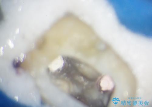 ぷくっと腫れた歯肉が気になる　根管治療とセラミックの治療前