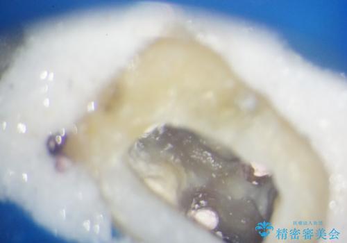 ぷくっと腫れた歯肉が気になる　根管治療とセラミックの治療中