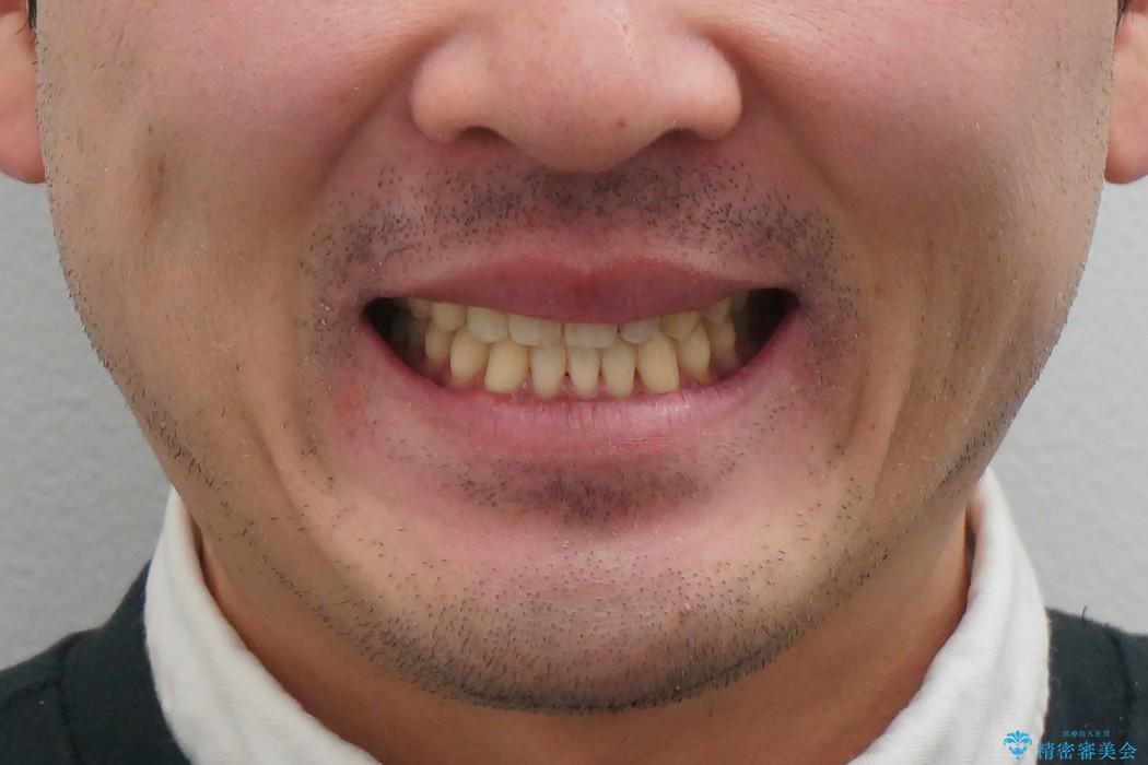 受け口、八重歯　変則的な抜歯の治療後（顔貌）