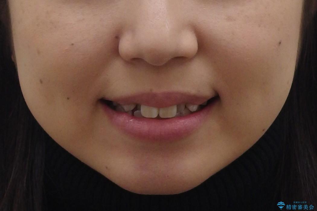 20代女性　前歯のがたがた　後ろに引っ込んでいる歯があるの治療前（顔貌）