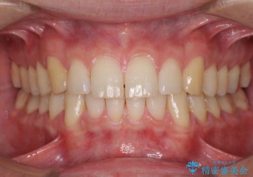 インビザラインによる矯正治療と銀歯の審美治療