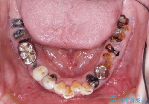虫歯だらけの口腔内　全顎治療