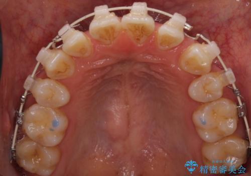 下の前歯が一本少ない　ワイヤーによる出っ歯の矯正治療の治療中
