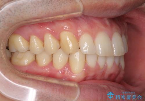 インビザラインによる矯正治療と銀歯の審美治療の治療後