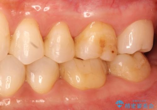 金属→セラミックへのやり直し　予想以上に深い虫歯とその処置の治療後