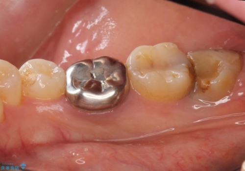 40代女性　親知らずを放置　手前の歯が虫歯にの治療前