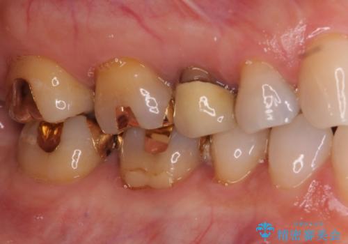 セラミッククラウンによる奥歯の虫歯治療　の治療前