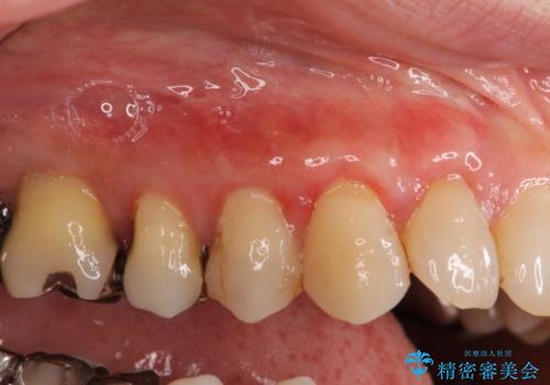 歯根が露出している歯の歯肉再生　根面被覆術の治療中