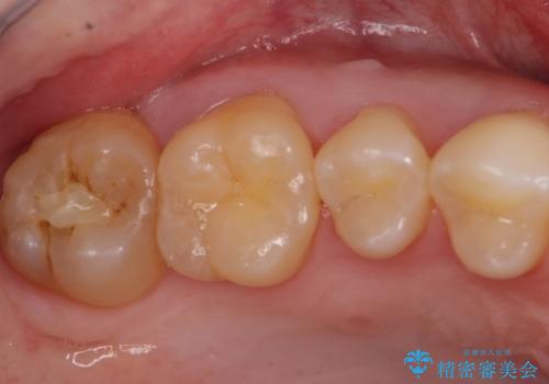20代男性　上の奥歯のレジン修復下の虫歯　の治療前