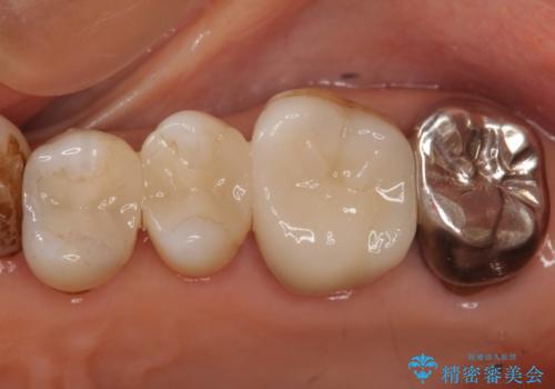 60代女性　銀歯の下が虫歯　隣も虫歯の治療後