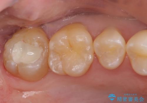20代男性 上の奥歯のレジン修復下の虫歯　の治療中