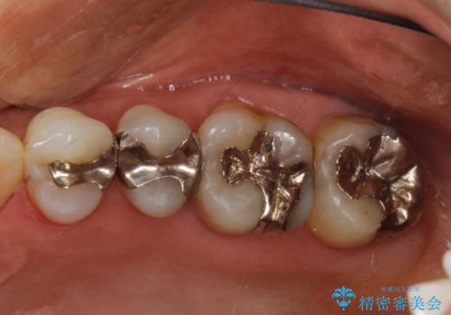 金属→セラミックへのやり直し　予想以上に深い虫歯とその処置の治療前