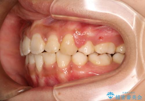 前歯のガタガタ・八重歯治したい　ワイヤーによる矯正の治療後