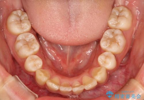 前歯のガタガタ・八重歯治したい　ワイヤーによる矯正の治療後