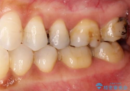 金属→セラミックへのやり直し　予想以上に深い虫歯とその処置の治療前