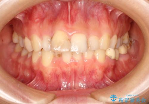 根管治療で変色した歯をセラミックで白くの症例 治療前