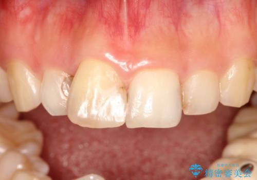 根管治療で変色した歯をセラミックで白くの治療前