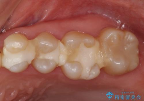治療途中で放置　上の奥歯3本をセラミックインレーに　2年後も良好な状態ですの治療前