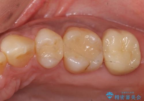 40代女性　全体的にしっかり虫歯を治療したい　の治療後