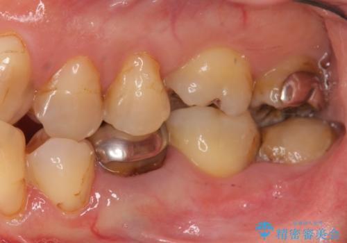 40代女性　親知らずを放置　手前の歯が虫歯にの治療前