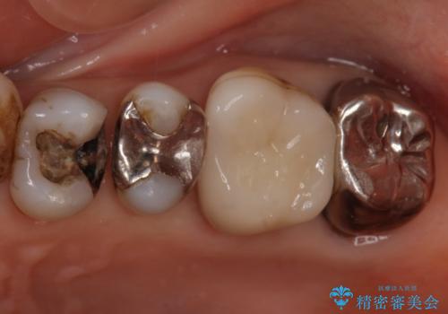 60代女性　銀歯の下が虫歯　隣も虫歯の治療中