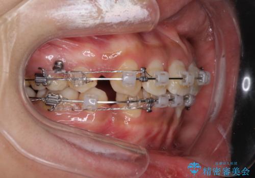 前歯のガタガタ・八重歯治したい　ワイヤーによる矯正の治療中