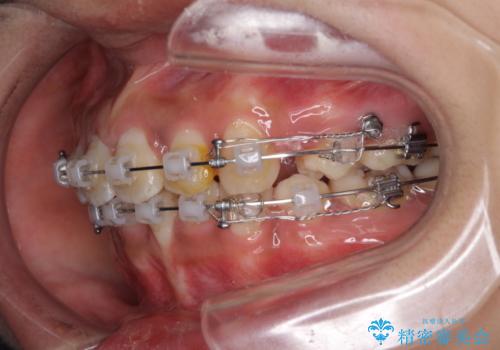 前歯のガタガタ・八重歯治したい　ワイヤーによる矯正の治療中