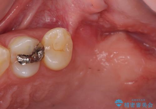 上顎臼歯部におけるインプラント治療の治療前
