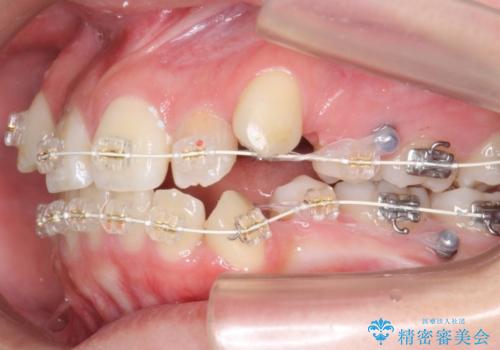 20代女性　八重歯をきれいに、前歯のがたがたの治療中