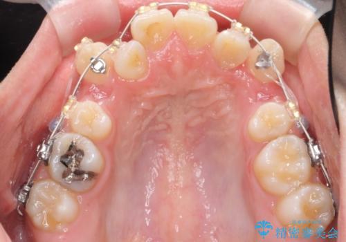 20代女性　八重歯をきれいに、前歯のがたがたの治療中