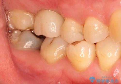 インプラントと部分矯正による奥歯のかみ合わせの改善の治療後