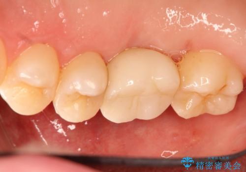 インプラントと部分矯正による奥歯のかみ合わせの改善の治療後