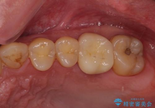 ぷくっと腫れた歯肉が気になる　根管治療とセラミックの治療後