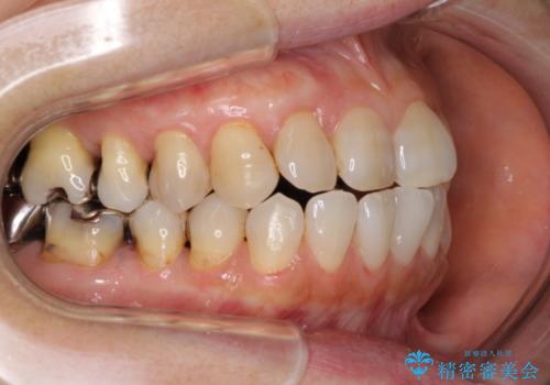 歯根が露出している歯の歯肉再生　根面被覆術の治療後