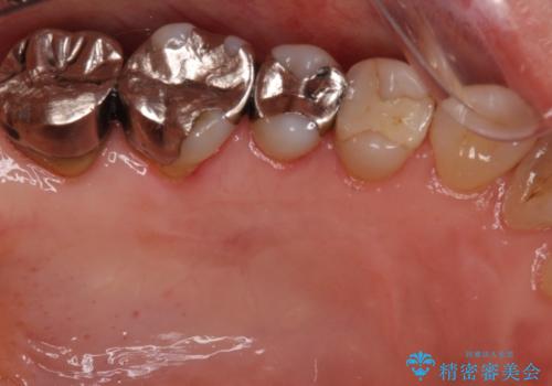 歯根が露出している歯の歯肉再生　根面被覆術の治療後