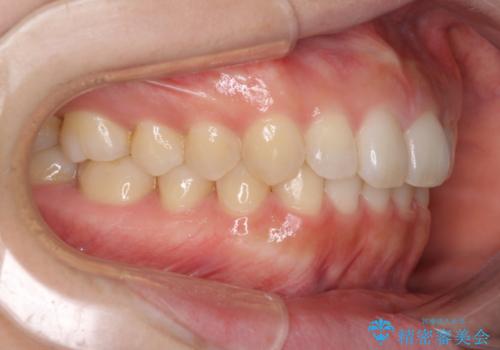 出ている前歯を引っ込めたい　インビザラインによる矯正治療の治療後