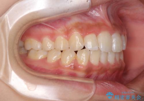 ワイヤー矯正とマウスピース矯正を併用して、短期間で歯列矯正の治療後