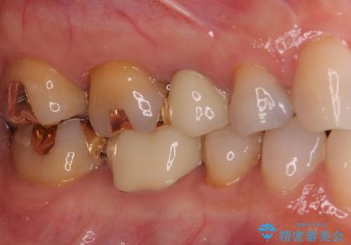 セラミッククラウンによる奥歯の虫歯治療　
