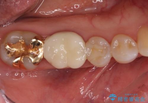 セラミッククラウンによる奥歯の虫歯治療　の治療後