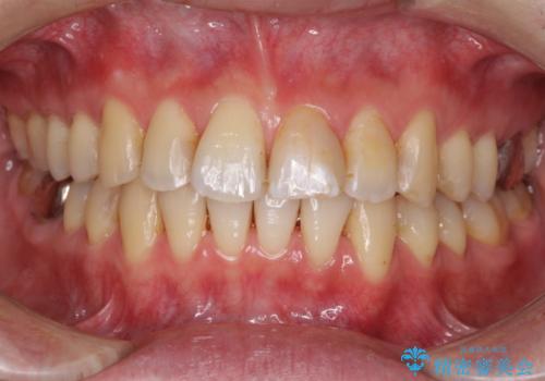 上下前歯のでこぼこをきれいに　インビザラインによる歯列矯正