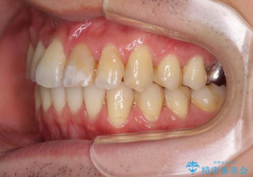 上下前歯のでこぼこをきれいに　インビザラインによる歯列矯正の治療後