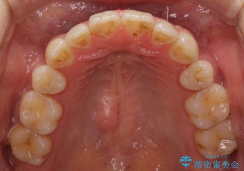 下の前歯が一本少ない　ワイヤーによる出っ歯の矯正治療の治療後