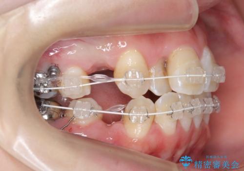 20代女性　前歯のがたがた　後ろに引っ込んでいる歯があるの治療中