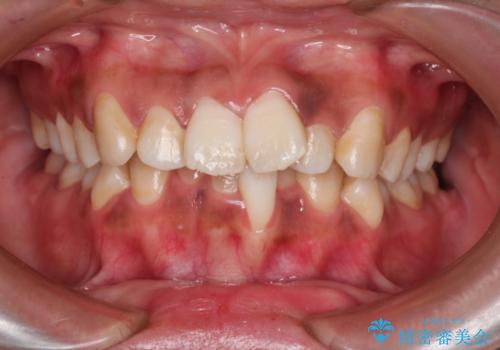 前歯のガタガタ・八重歯治したい　ワイヤーによる矯正の治療前
