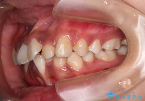 前歯のガタガタ・八重歯治したい　ワイヤーによる矯正の治療前
