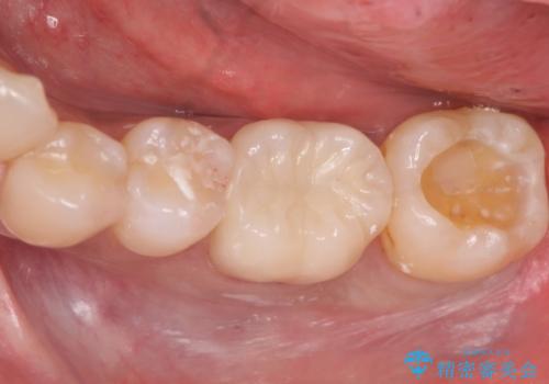 40代男性　銀歯を全て白くしたい　マウスピース矯正も希望の治療中